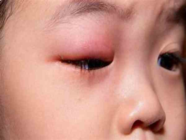 Lẹo mắt là gì?