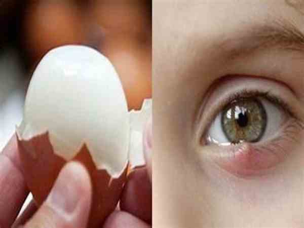 Chữa bằng trứng gà